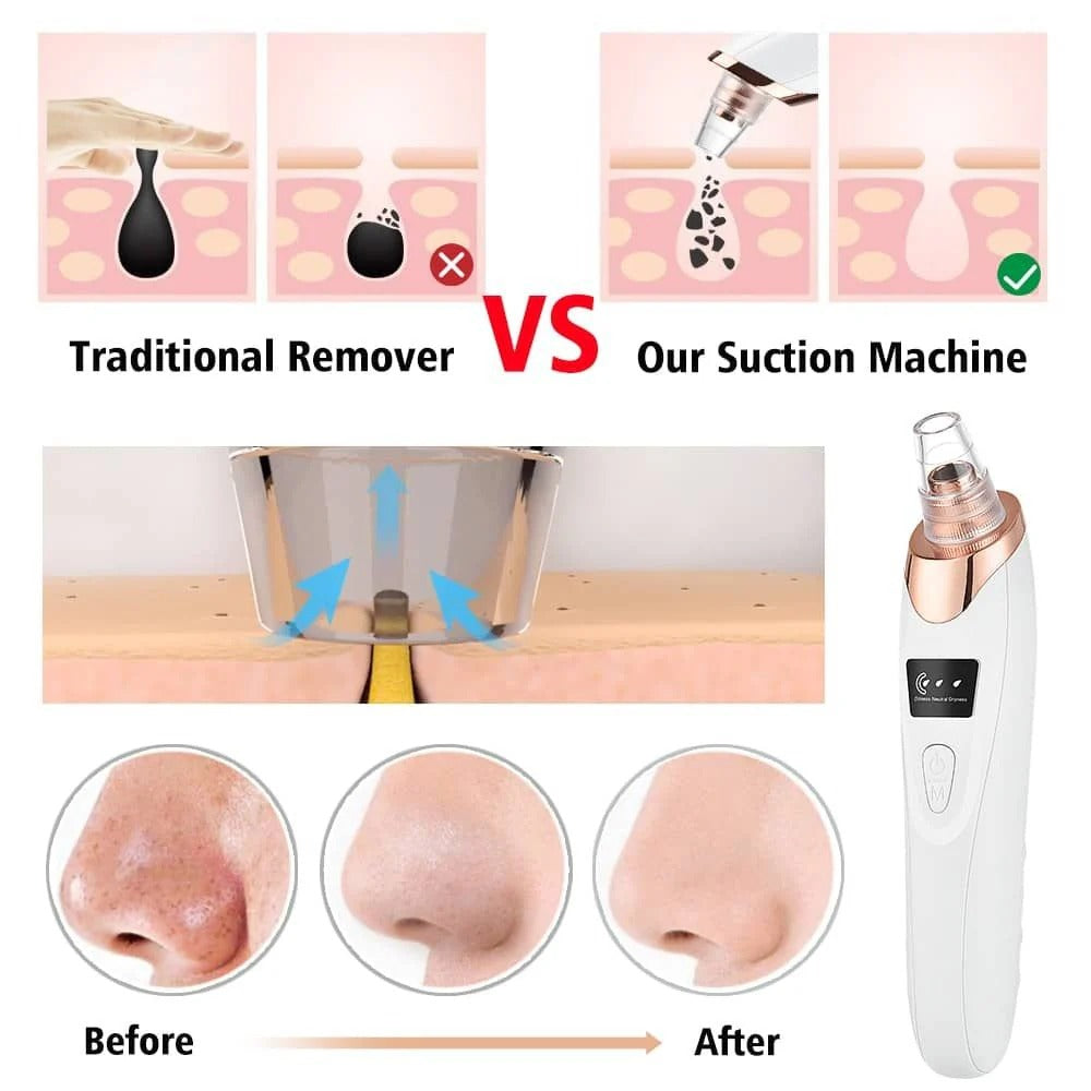 lectric Blackhead Remover | Vacuum Acne & Pore Cleaner | 5 Heads Suction Machine | Skin Care & Exfoliating Tool